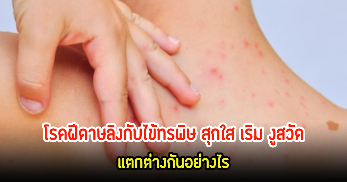 ฝีดาษลิง กับ ไข้ทรพิษ-ตุ่มสุกใส อาการแตกต่างกันอย่างไร?