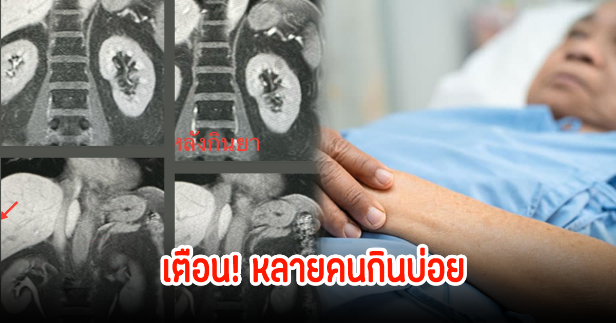 หลายคนกินบ่อย ชายวัยอายุ 64 ปี ป่วยฝีในตับ หมอเตือน! อย่ากินกินพืชน้ำสดๆ