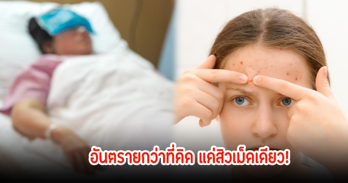 แค่สิวเม็ดเดียว! หนุ่มวัย 30 ปี ถูกหามเข้าไอซียูด่วน พบติดเชื้อเนื้อเน่า หมอเตือนสิวแบบไหนห้ามบีบเด็ดขาด