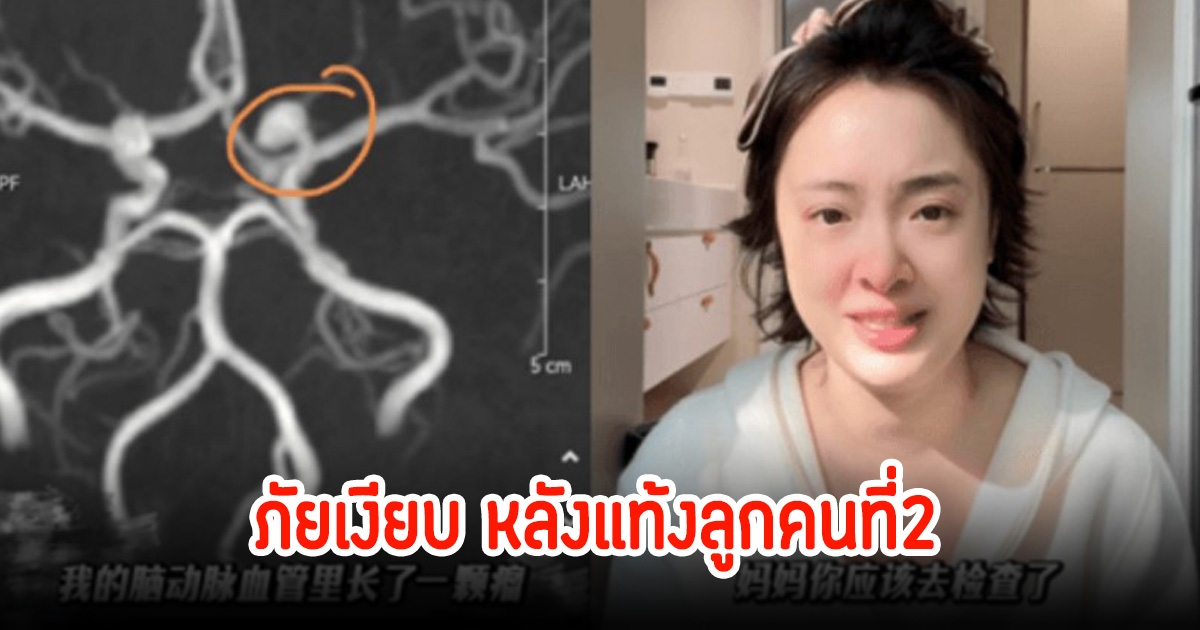 ภัยเงียบที่ซ่อนอยู่ ดาราสาวแท้งลูกคนที่2 ทำให้ตรวจเจอโรคในสมองที่คาดไม่ถึง (ข่าวต่างประเทศ)