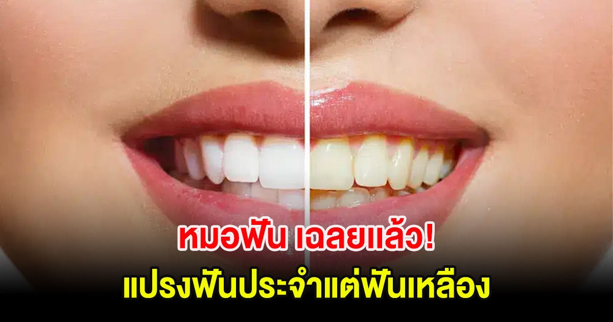 หมอฟัน เฉลยเเล้ว! สาเหตุแปรงฟันประจำแต่ฟันเหลือง เผย 2 ข้อ ที่หลายคนชอบทำ