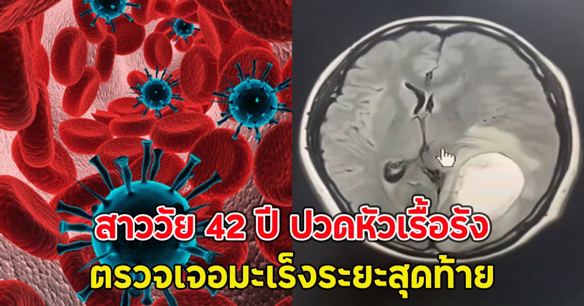 หมอเตือนเอง!! สาววัย 42 ปี ปวดหัวเรื้อรัง ตรวจเจอมะเร็งระยะสุดท้าย